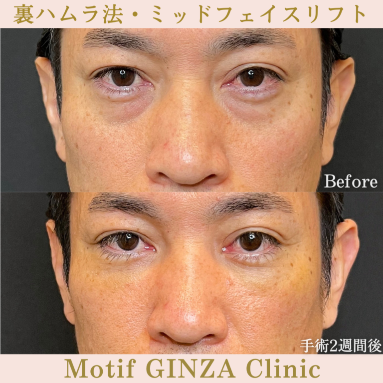 裏ハムラ法・ミッドフェイスリフト（手術1か月）の写真3