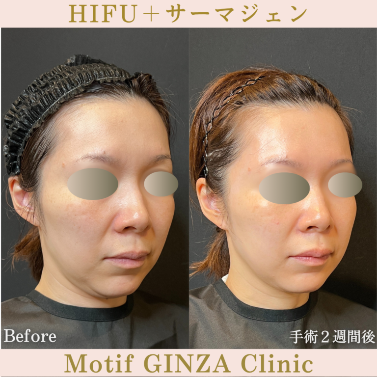 HIFU・サーマジェン(手術1ヶ月)の写真2