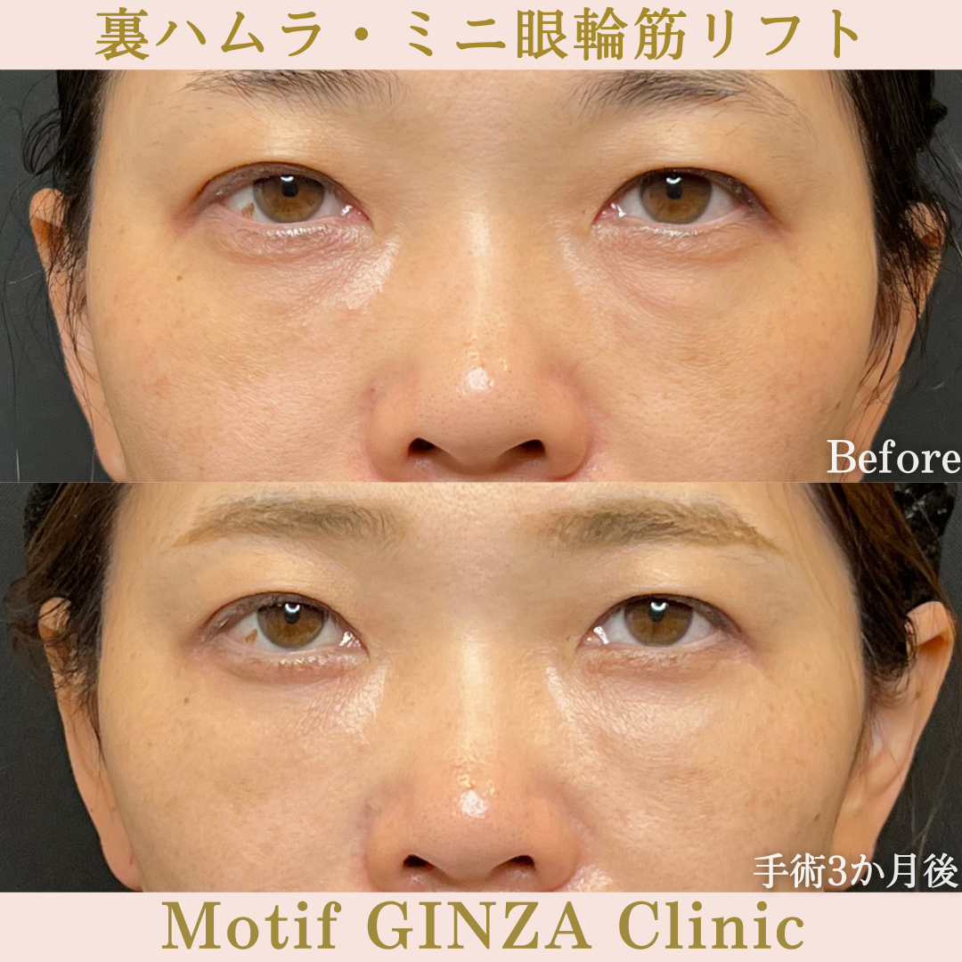 裏ハムラ法・ミニ眼輪筋リフト(手術10か月)の写真5