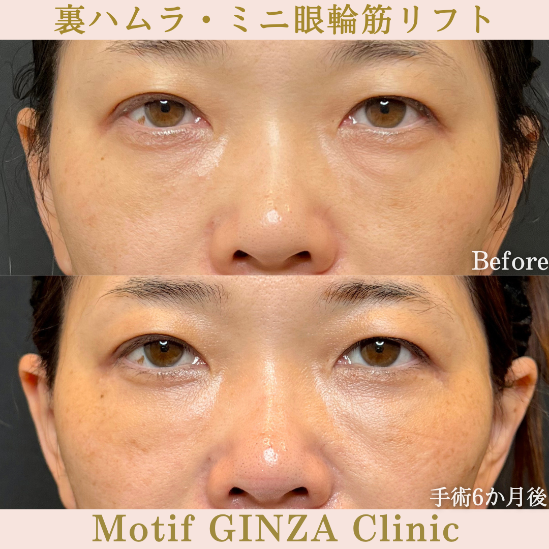 裏ハムラ法・ミニ眼輪筋リフト(手術10か月)の写真3