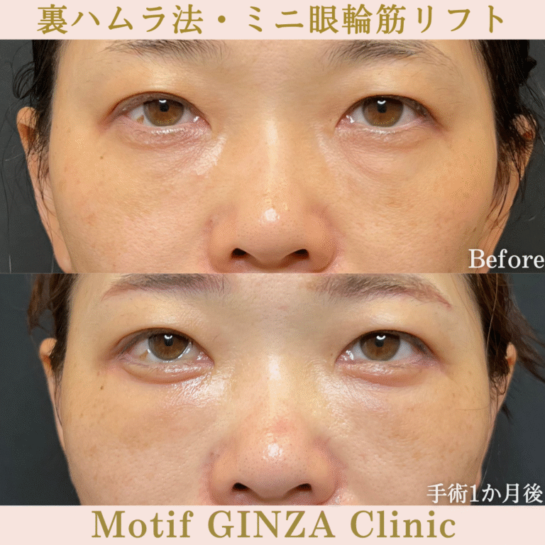 裏ハムラ法・ミニ眼輪筋リフト（手術１か月）
