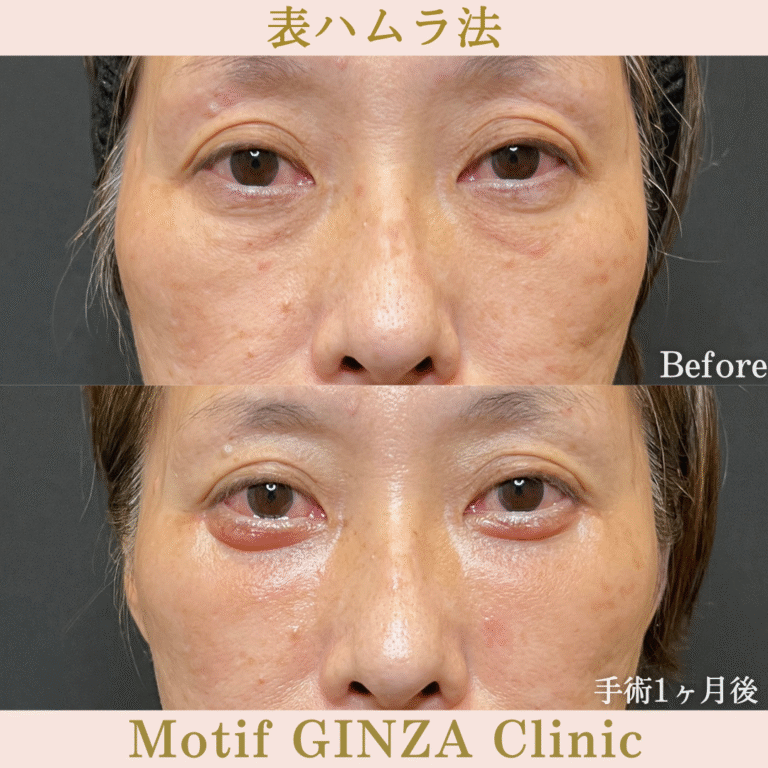 切開式下眼瞼たるみ取り（手術６か月）の写真5