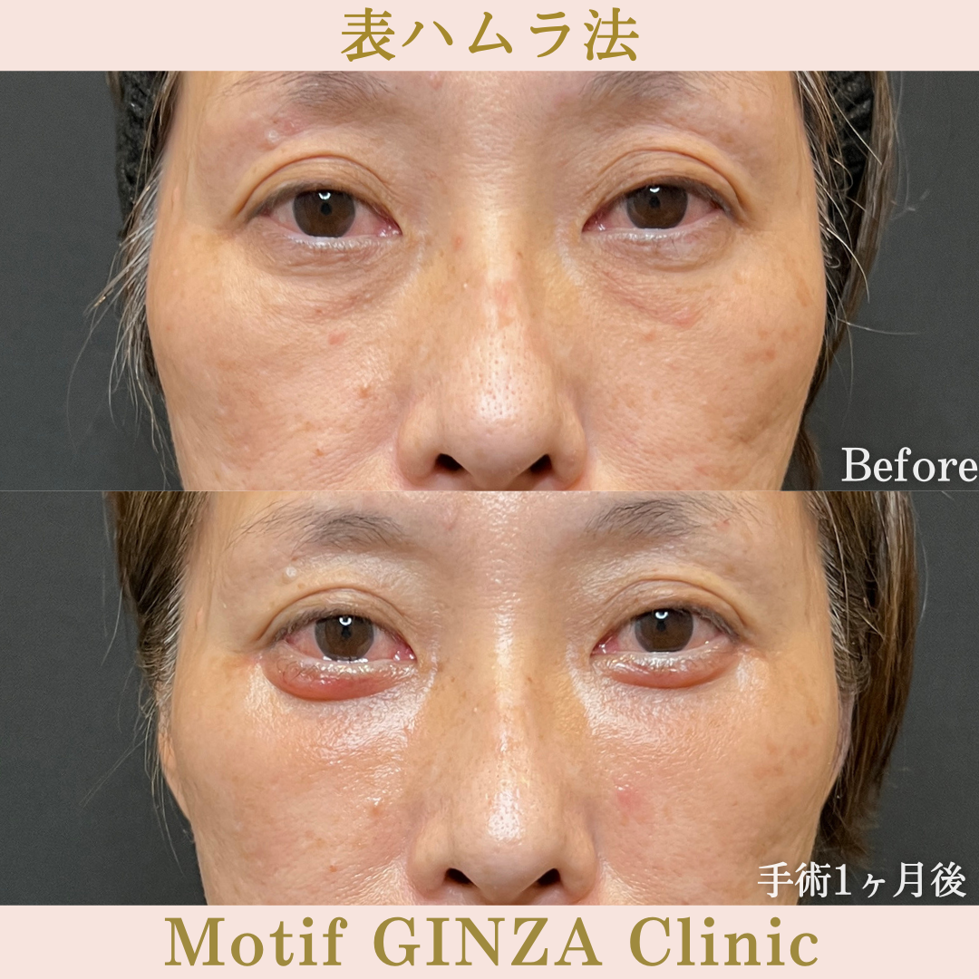 切開式下眼瞼たるみ取り（手術６か月）の写真5