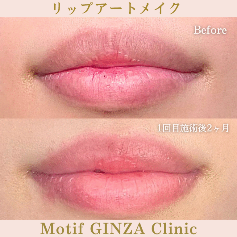 リップアートメイク（施術１回目２か月）