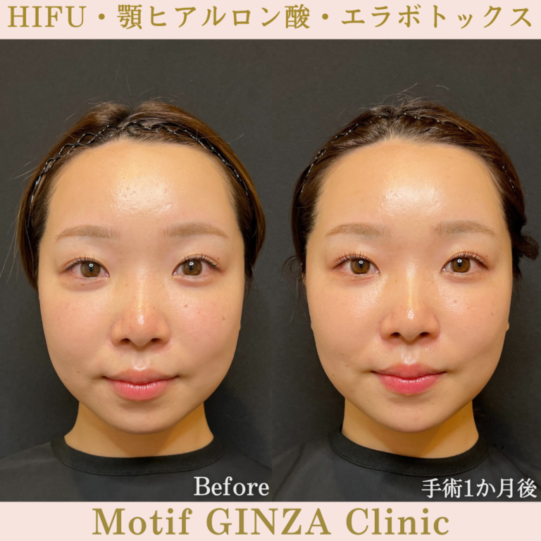 HIFU・顎ヒアルロン酸・エラボトックス（手術１か月）