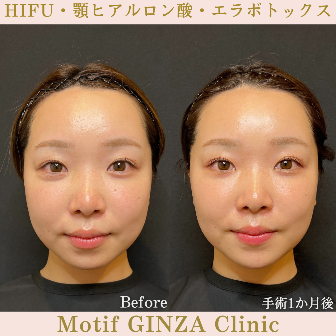 HIFU・顎ヒアルロン酸・エラボトックス（手術１か月）の写真