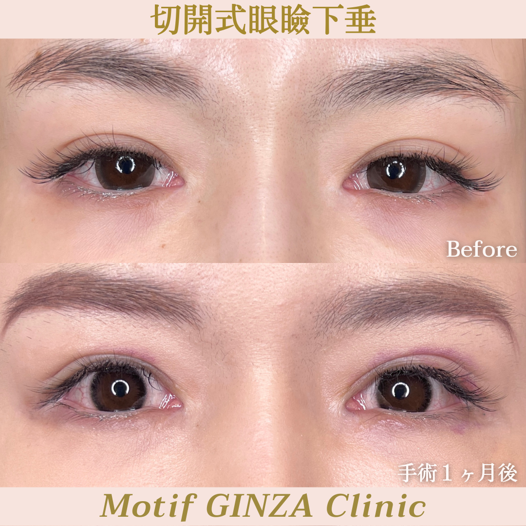 切開式眼瞼下垂手術(手術3ヶ月)の写真3