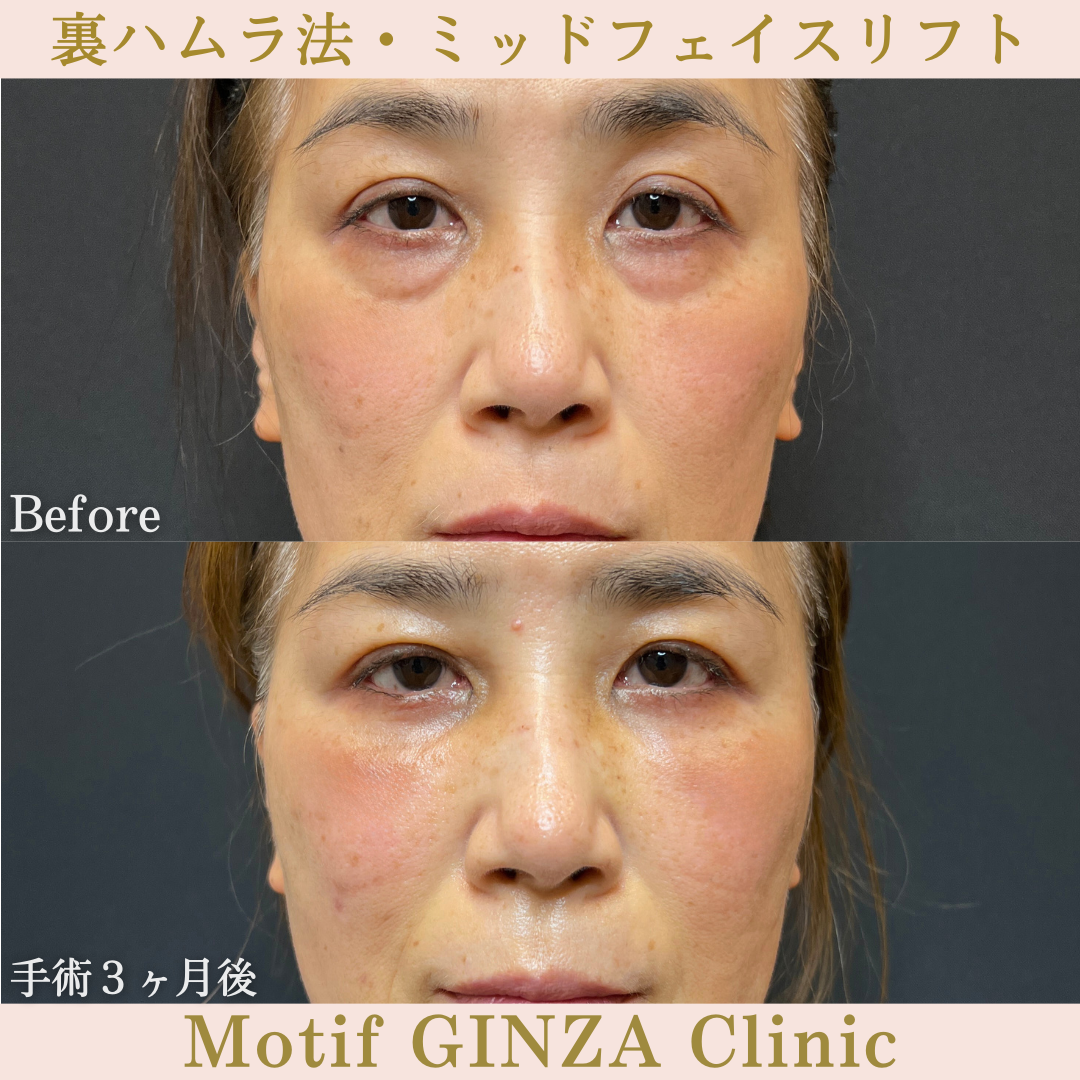 裏ハムラ法・ミッドフェイスリフト（手術3年7ヶ月）の写真3