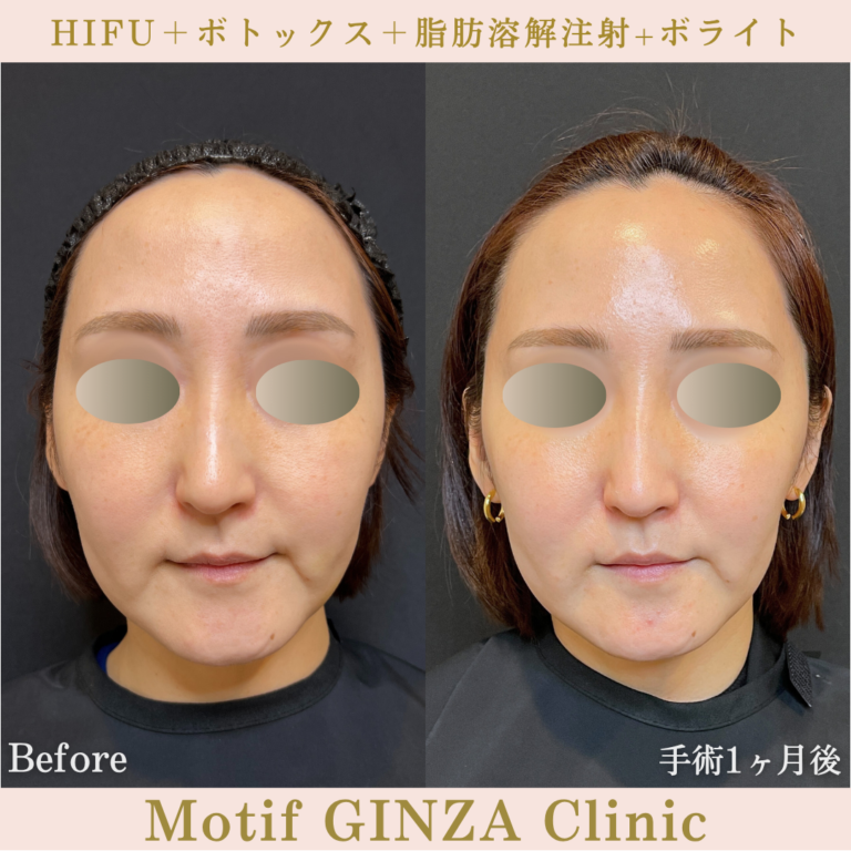 ヒアルロン酸注射 | 美容外科、婦人科形成の東京のモティーフ銀座