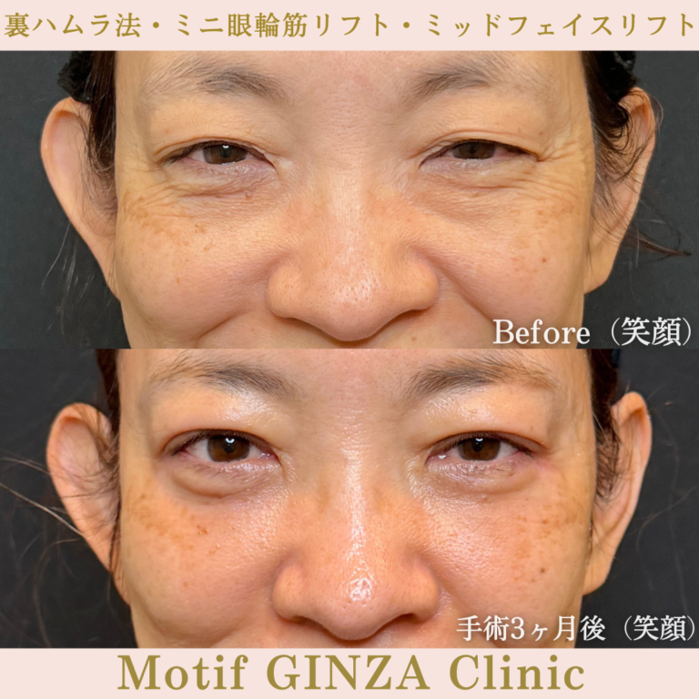 裏ハムラ法・ミニ眼輪筋リフト・ミッドフェイスリフト（手術３か月）の写真2