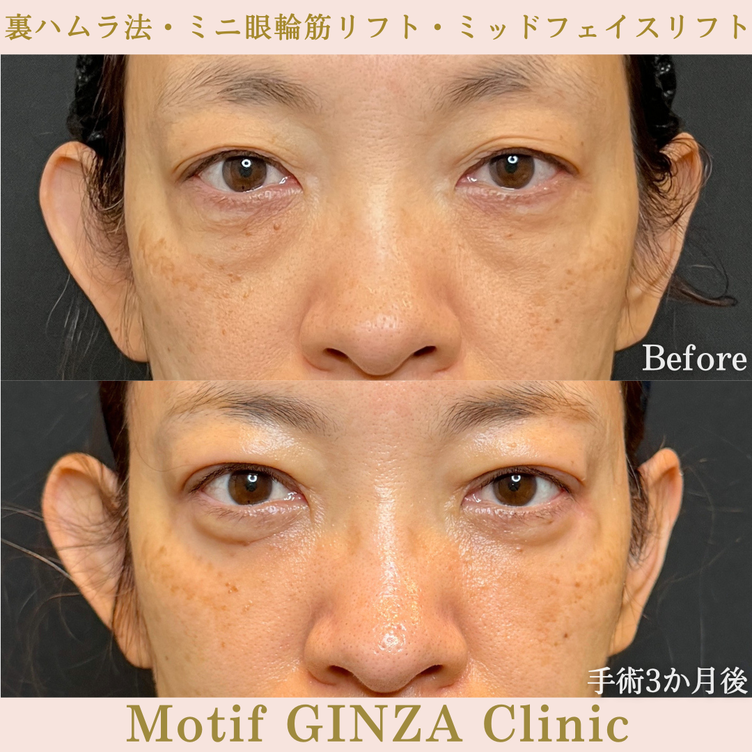裏ハムラ法・ミニ眼輪筋リフト・ミッドフェイスリフト(手術9か月)の写真4