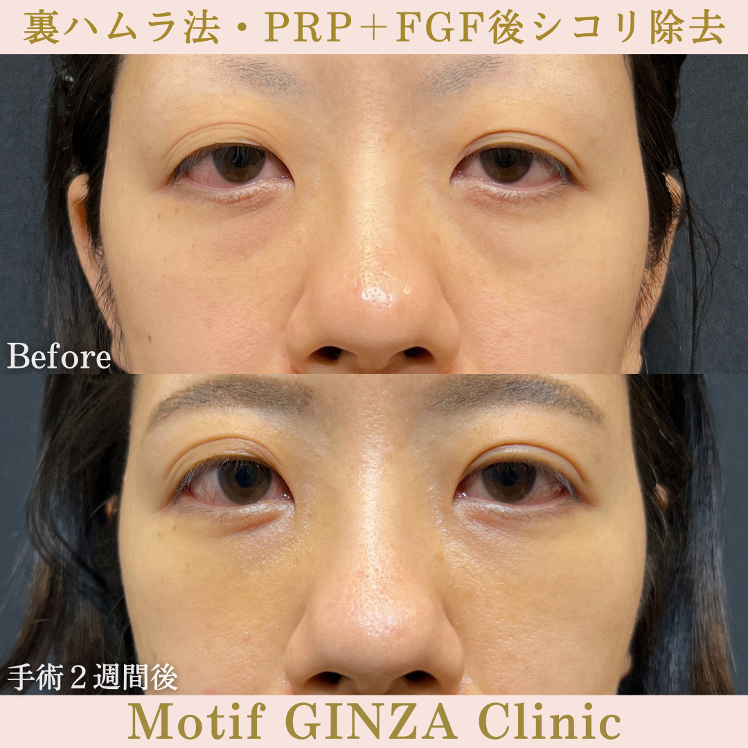 裏ハムラ法・PRP+FGF後シコリ除去(手術3ヶ月)の写真5