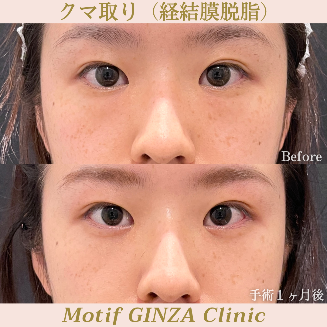 経結膜脱脂（手術１ヶ月）の写真