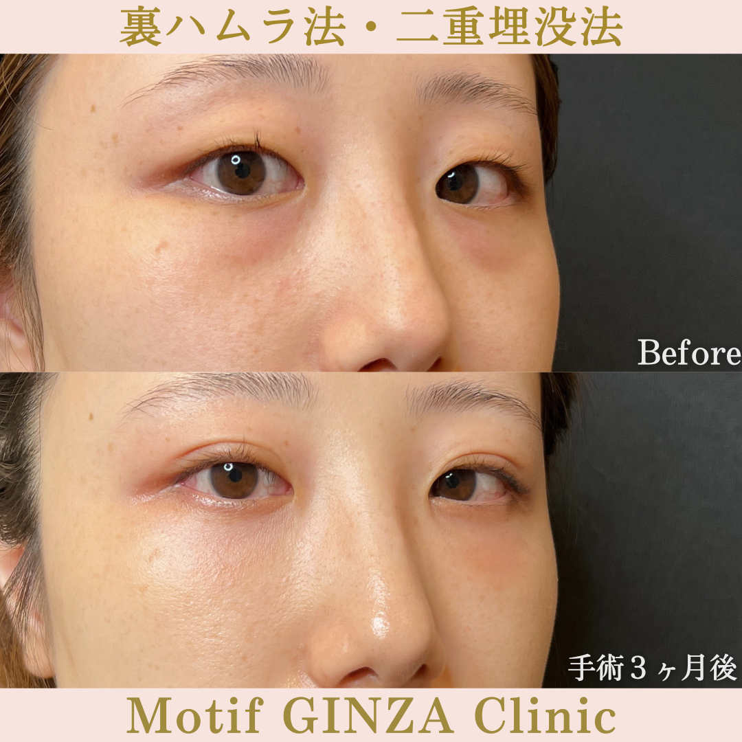裏ハムラ法・二重埋没法(手術2年3ヶ月)の写真4