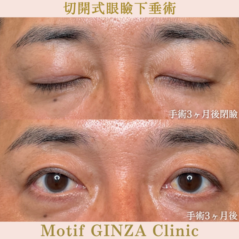 切開式眼瞼下垂手術(手術3か月)の写真2