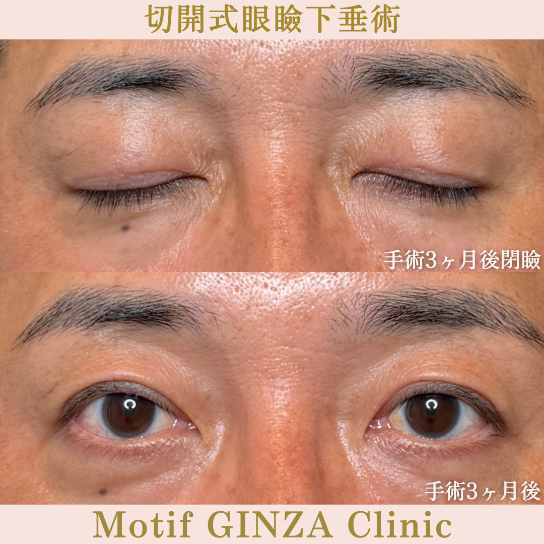 切開式眼瞼下垂手術(手術3か月)の写真2