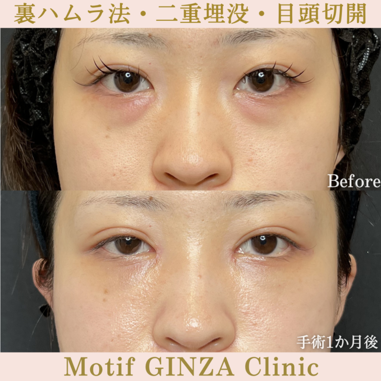 裏ハムラ法・二重埋没法・目頭切開(手術3か月)の写真4