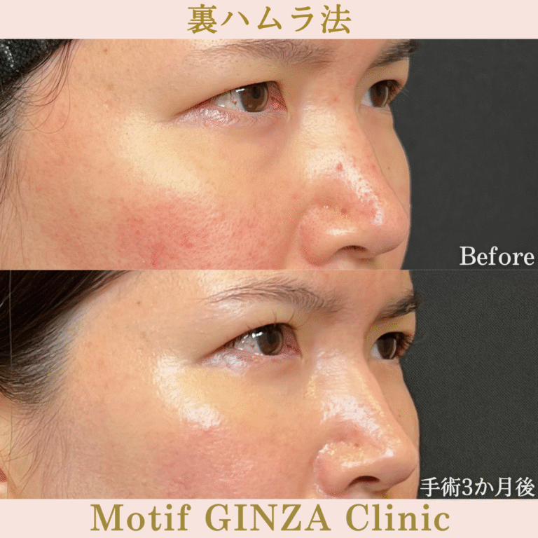 裏ハムラ法（手術３か月）の写真2