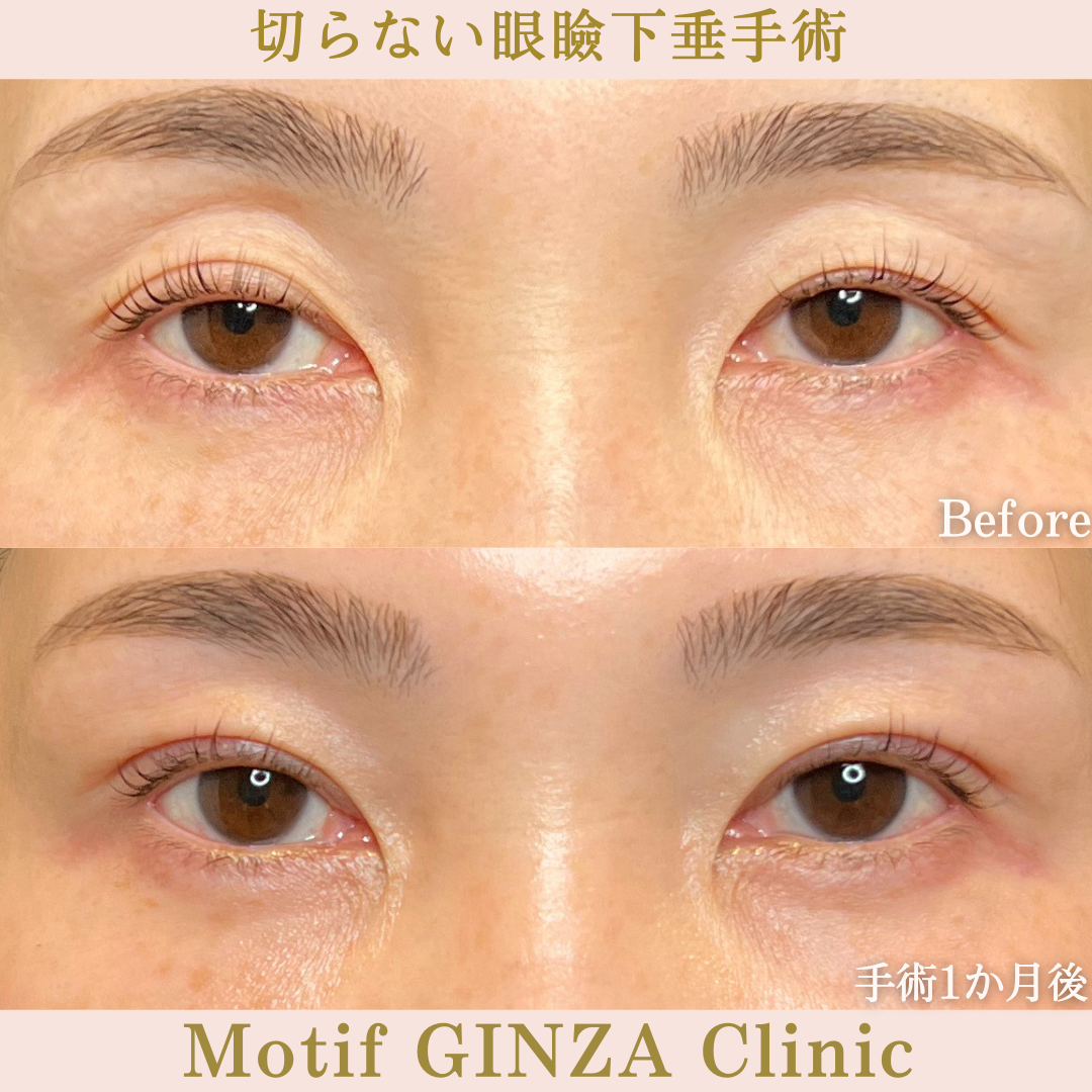 切らない眼瞼下垂手術（手術１か月）の写真