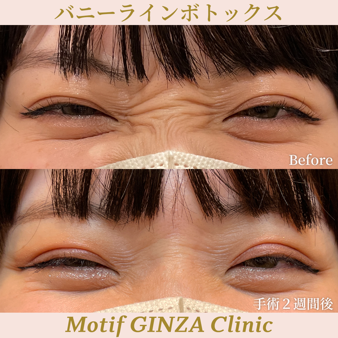 バニーラインボトックス（手術２週間）の写真