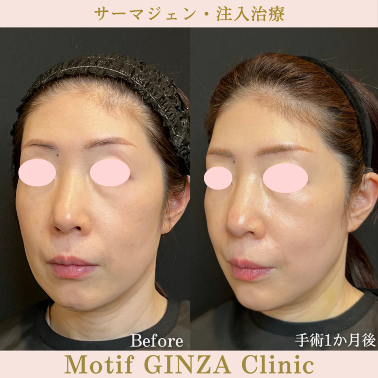 サーマジェン・注入治療（手術1か月）の写真2