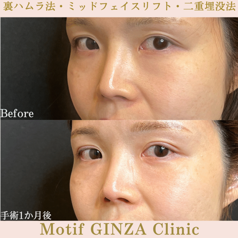 裏ハムラ法・ミッドフェイスリフト・二重埋没法（手術３か月）の写真4
