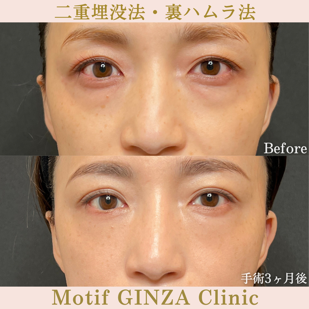 二重埋没法・裏ハムラ法（手術３か月）の写真