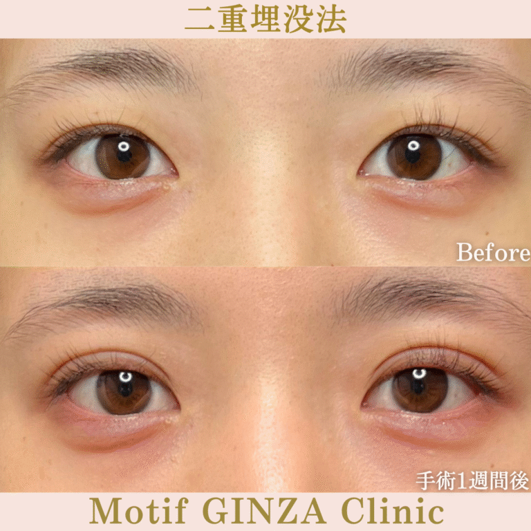 二重埋没法(手術1か月)の写真2