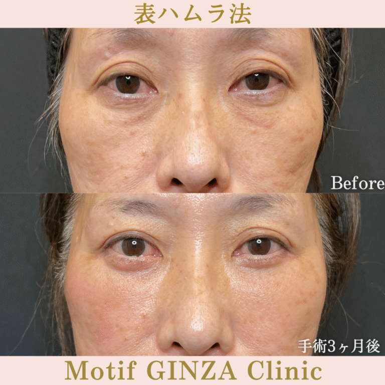 切開式下眼瞼たるみ取り（手術６か月）の写真3