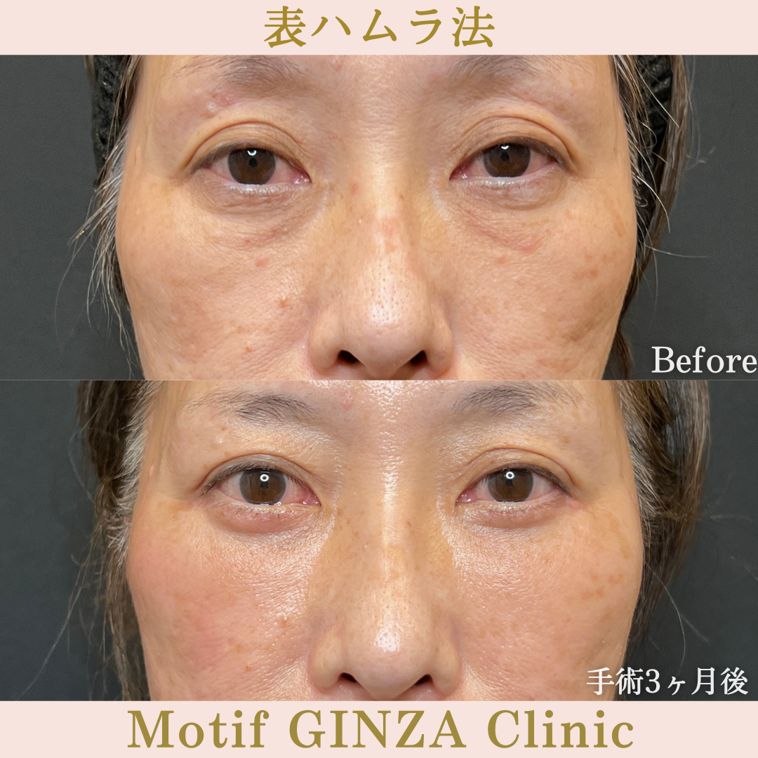切開式下眼瞼たるみ取り（手術６か月）の写真3