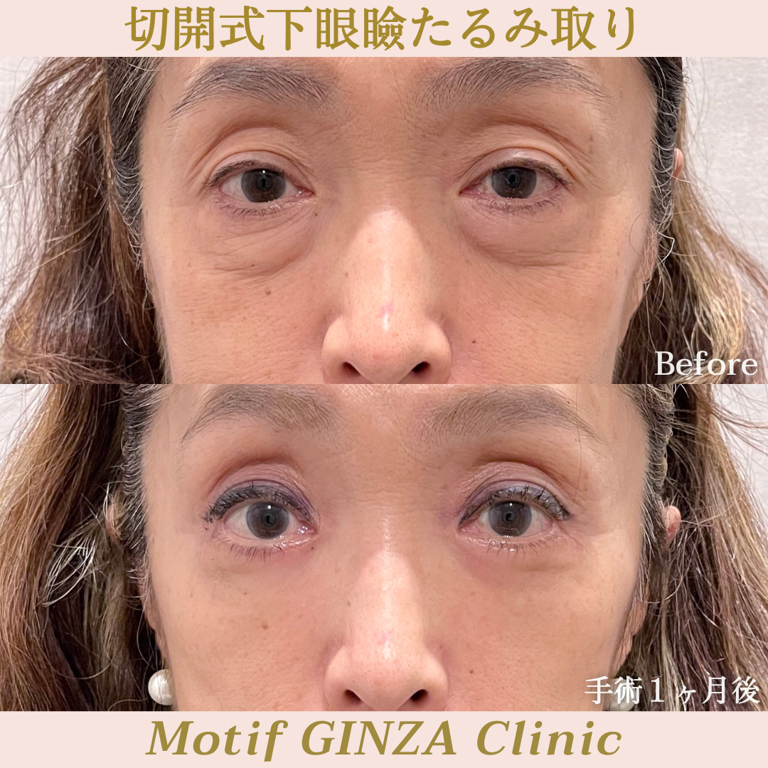 切開式下眼瞼たるみ取り(ハムラ法)(手術3ヶ月)の写真3