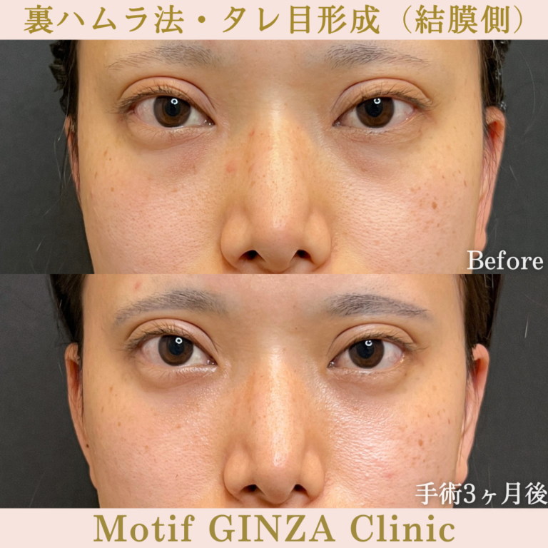裏ハムラ法・タレ目形成（結膜側）（手術３か月）