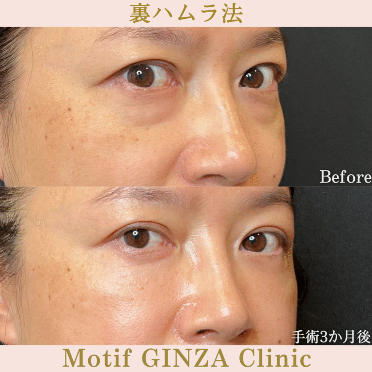 裏ハムラ法（手術３か月）の写真2