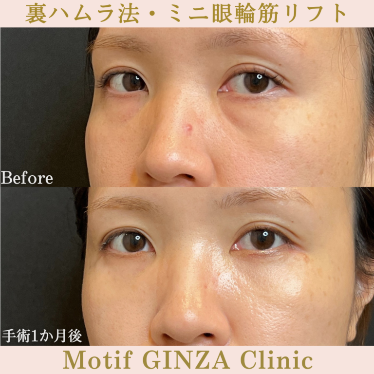裏ハムラ法・ミニ眼輪筋リフト(手術1か月)の写真2