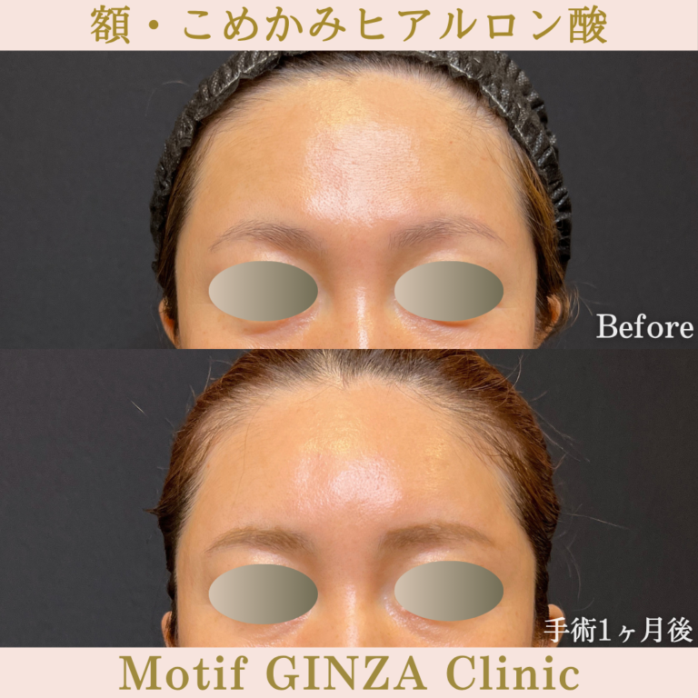 ヒアルロン酸注射 | 美容外科、婦人科形成の東京のモティーフ銀座