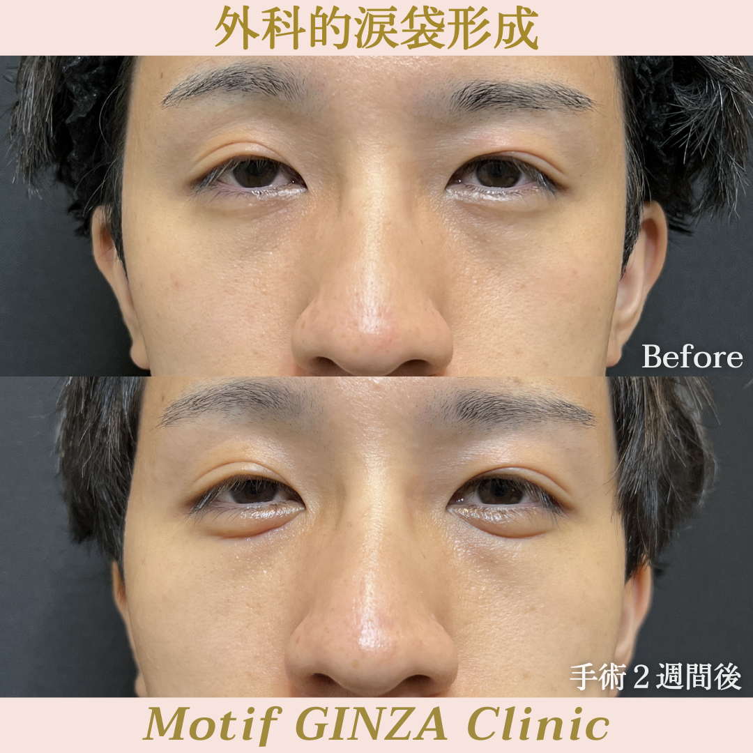 外科的涙袋形成(手術1ヶ月)の写真2