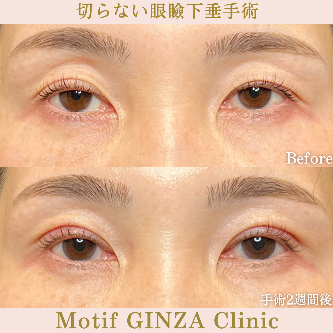 切らない眼瞼下垂手術(手術1か月)の写真2