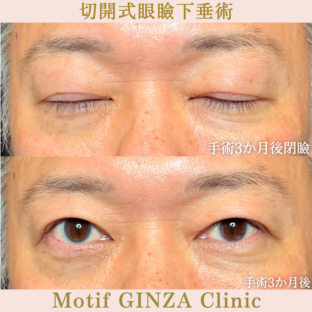 切開式眼瞼下垂手術（手術3か月）の写真2
