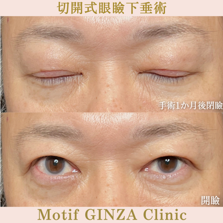 切開式眼瞼下垂手術(手術1か月)の写真2