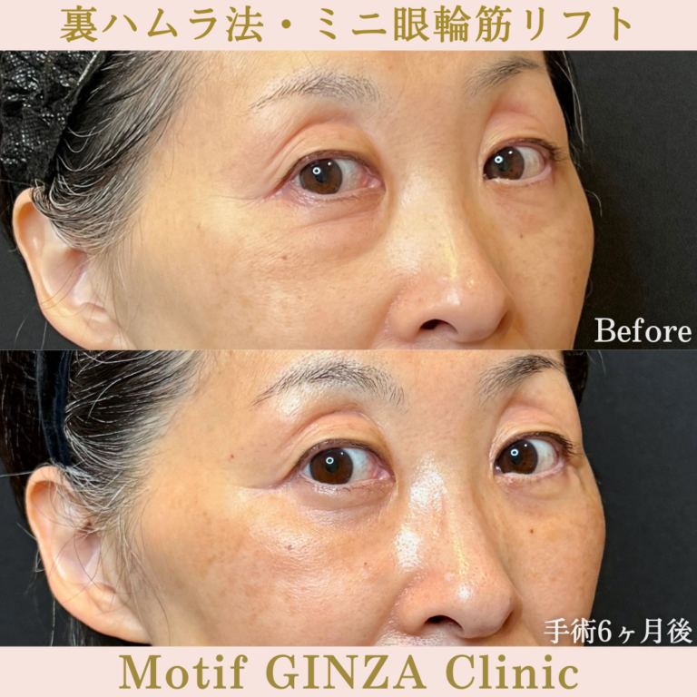 裏ハムラ法・ミニ眼輪筋リフト（手術6か月）の写真2
