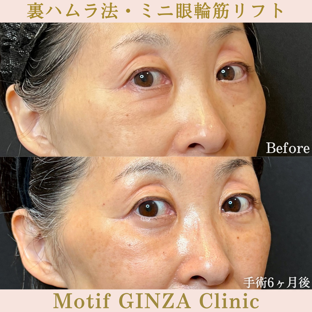 裏ハムラ法・ミニ眼輪筋リフト(手術6か月)の写真2