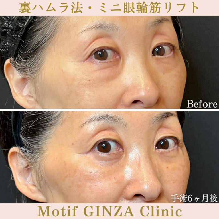 裏ハムラ法・ミニ眼輪筋リフト（手術6か月）の写真2