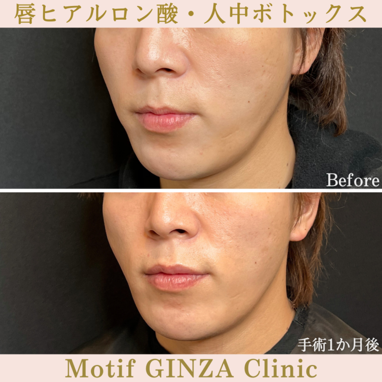 唇ヒアルロン酸・人中ボトックス（手術1か月）