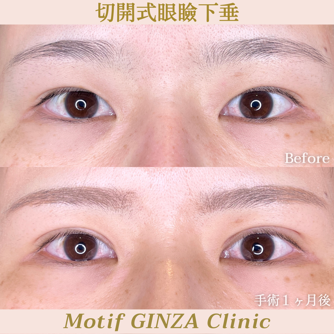 切開式眼瞼下垂手術（手術３ヶ月）の写真3