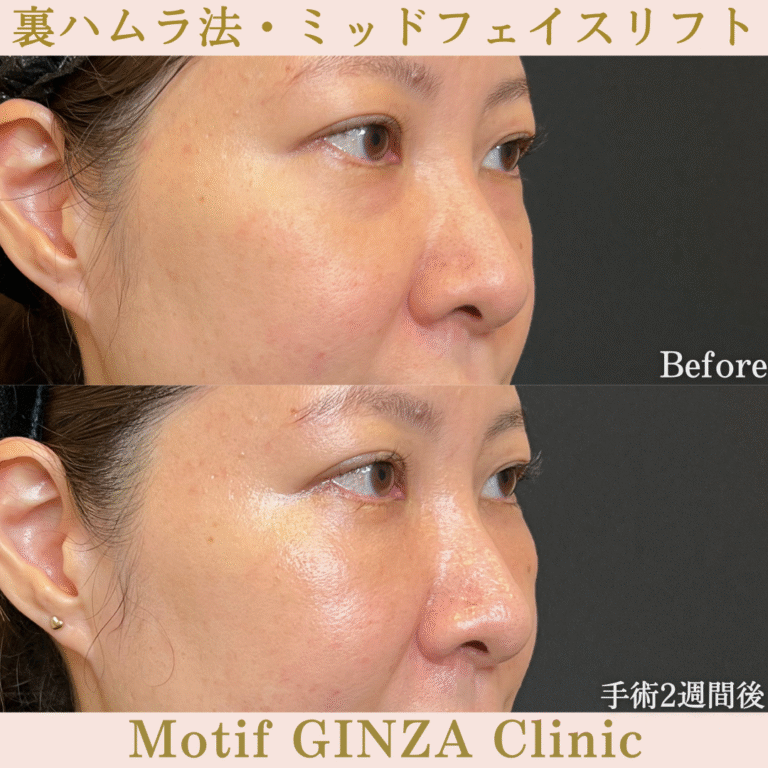 裏ハムラ法・ミッドフェイスリフト（手術３か月）の写真6