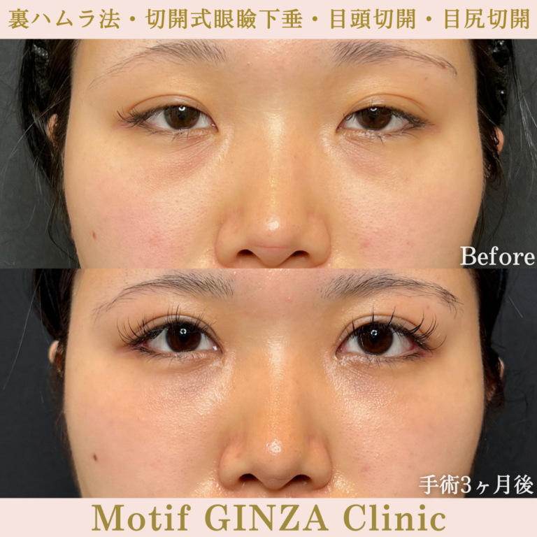 裏ハムラ法・切開式眼瞼下垂術・目頭切開・目尻切開(手術6か月)の写真4