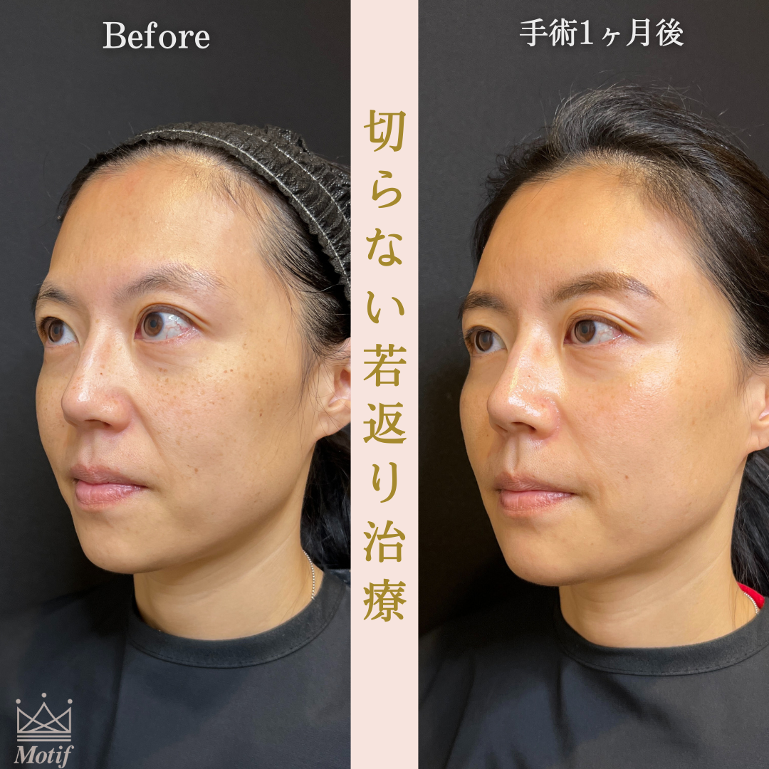 切らない若返り治療(手術1ヶ月)の写真2