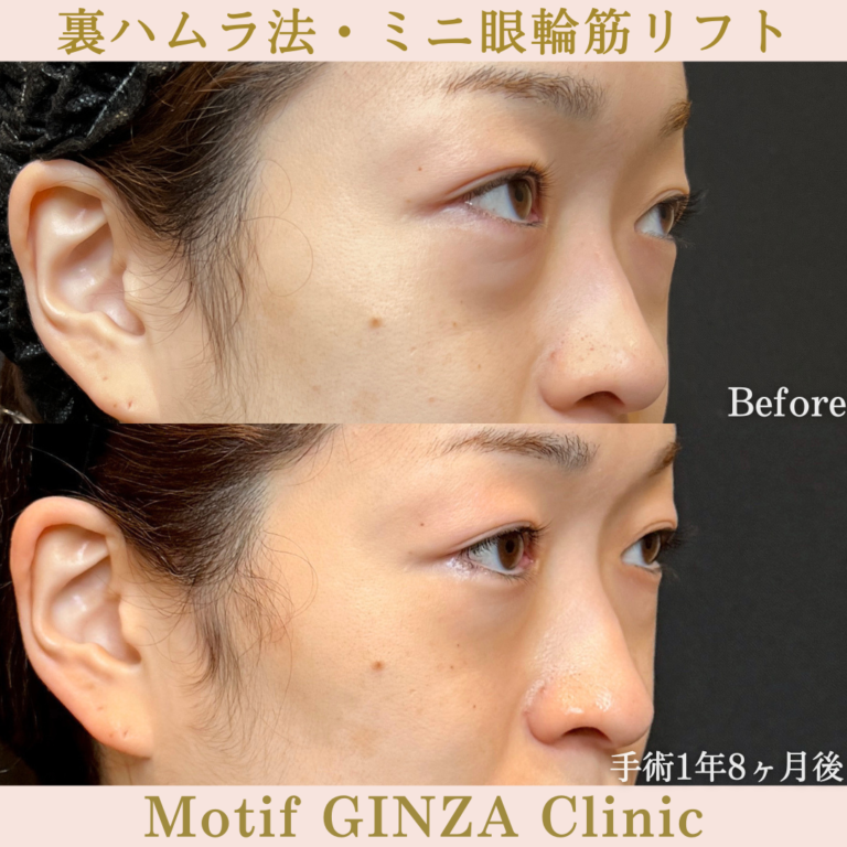 裏ハムラ法・ミニ眼輪筋リフト（手術1年8か月）の写真2