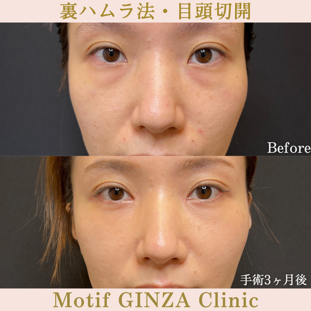 裏ハムラ法・目頭切開(手術6ヶ月)の写真3