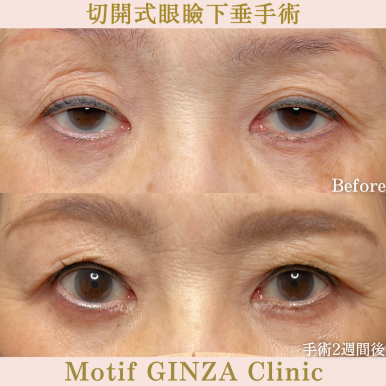 切開式眼瞼下垂手術(手術3か月)の写真4